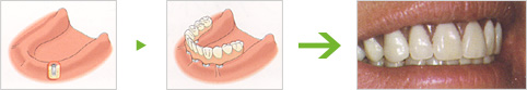 上顎または下顎の歯を完全に失った方のインプラント例