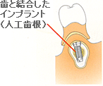 歯と結合したインプラント（人工歯根）