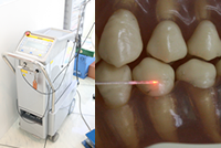 歯科用ヤグレーザーでの治癒促進